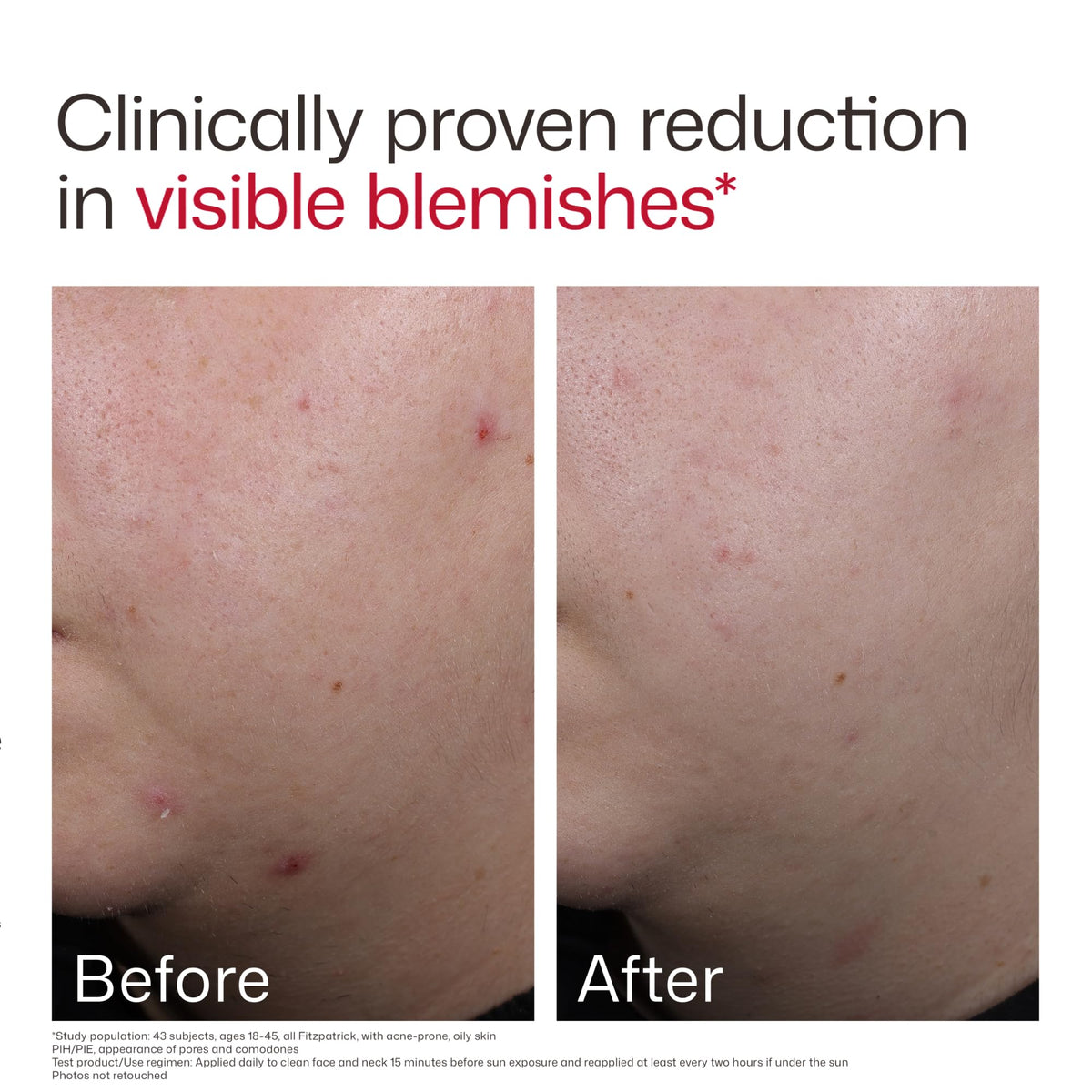 Eltamd UV Clear Face Sunscreen Spf, Oil-Free Sunscreen with Zinc Oxide, Dermatologist Recommended